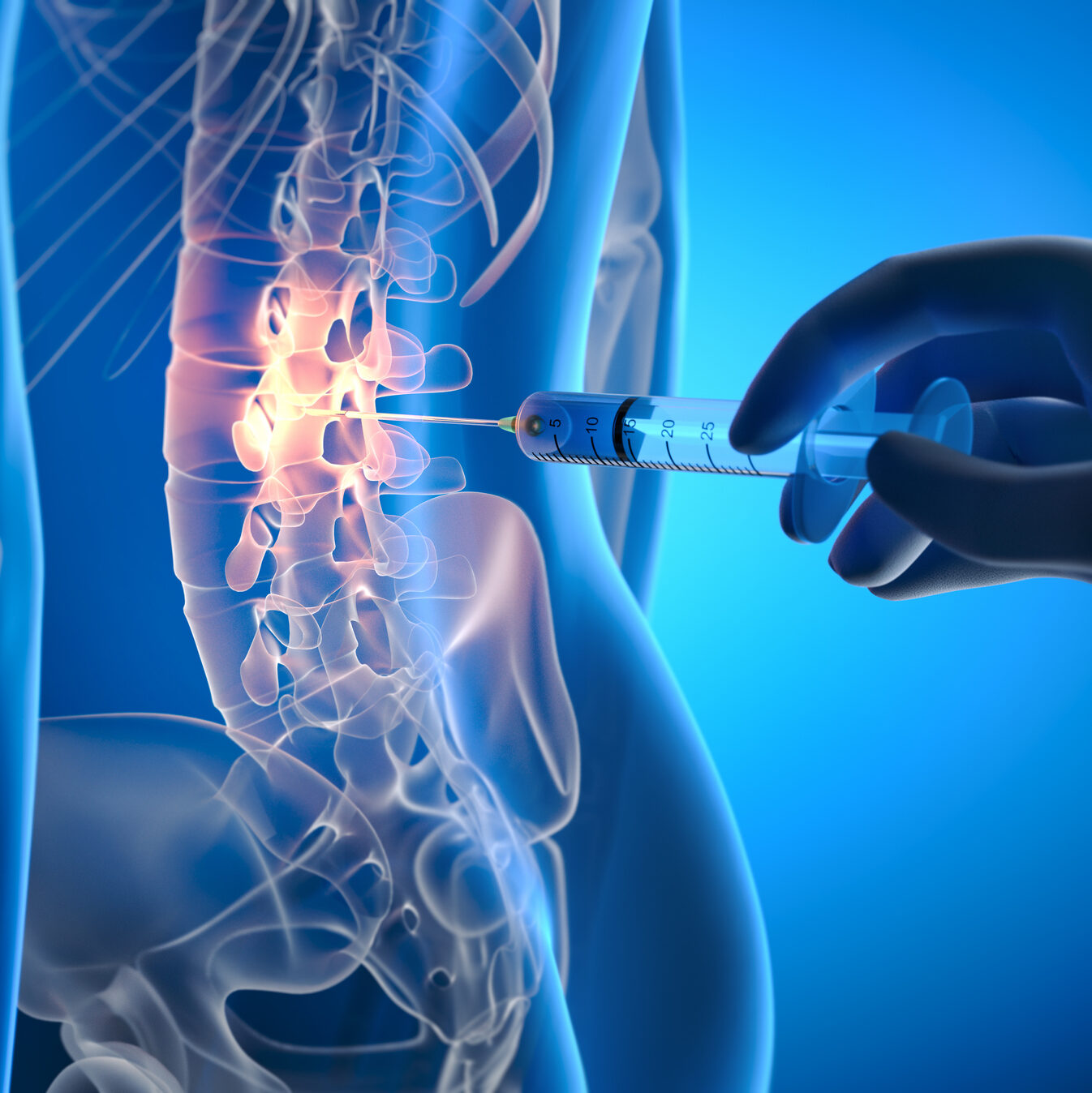 Spinal drug injection for lower back pain treatment