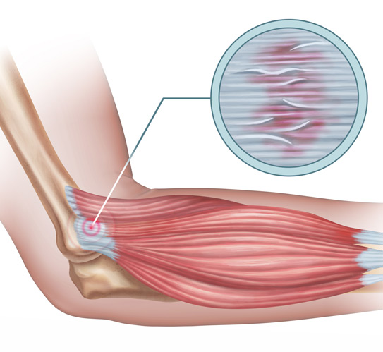 Diagram-showing-a-detail-of-the-damaged-tendon-tissue