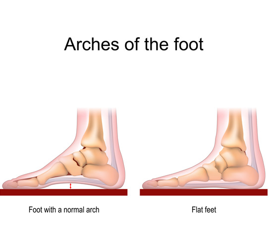 Foot-with-a-normal-arch-and-flat-feet