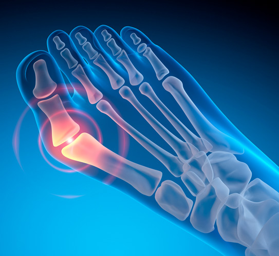 Illustrations-of-a-valgus-deformity-of-the-big-toe