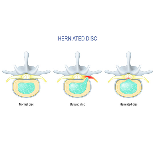Image-showing-difference-between-bulging-disc-and-herniated-disc