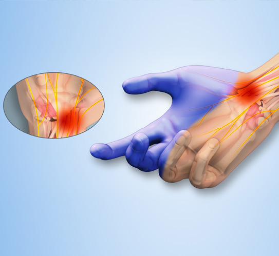 Image-showing-tingling-and-numbness-in-hand