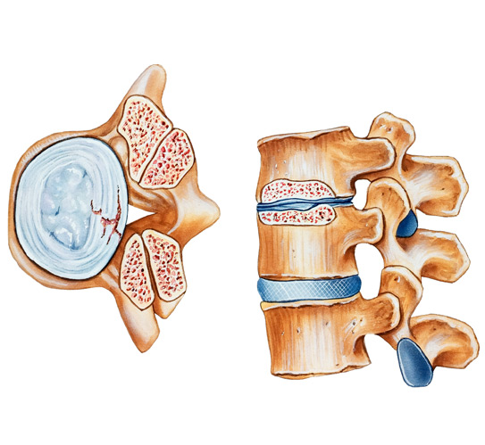 Image-shows-a-damaged-intervertebral-disc