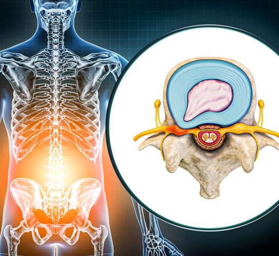 Lumbar-hernia-and-vertebra-with-herniated-disc-medical-diagram