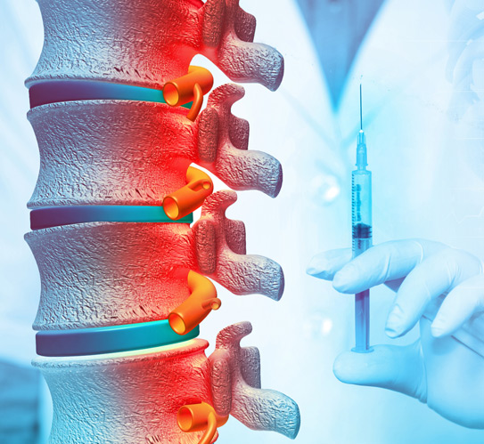 Spinal-column-treatment-with-epidural-injection