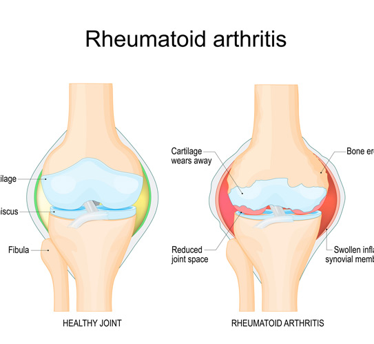 Vector-illustration-of-rheumatoid-arthritis-affecting-knee-joint