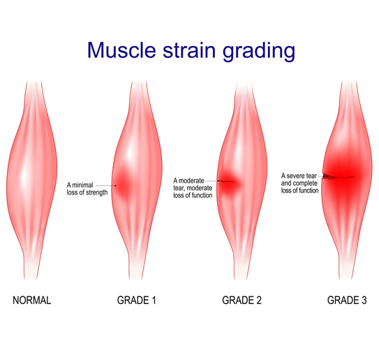 Vector-illustration-showing-different-grades-of-muscle-strain