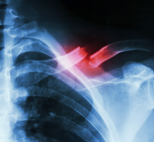 X-ray-showing-a-fracture-in-middle-left-clavicle