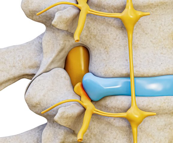 3D-rendering-illustration-of-spinal-nerve-compression