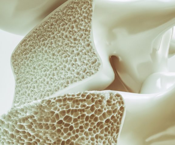 3D-rendering-image-showing-osteoporosis-effects-on-the-spine