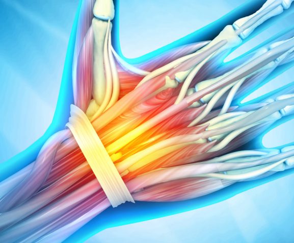 3d-illustration-of-wrist-bones-injury-and-wrist-pain