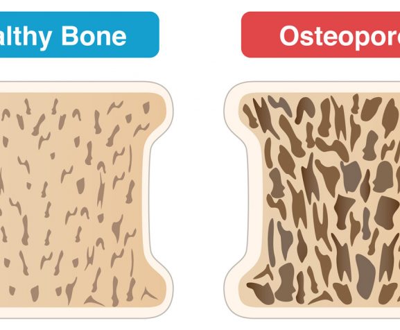 Comparison-of-cross-sectional-views-of-osteoporotic-and-normal-bone