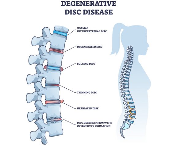 Degenerative-disc-disease-with-spine-and-vertebra-trauma-outline-diagram