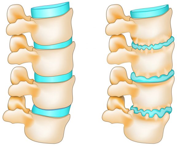 Degenerative-disc-with-osteophyte-formation-and-normal-spine