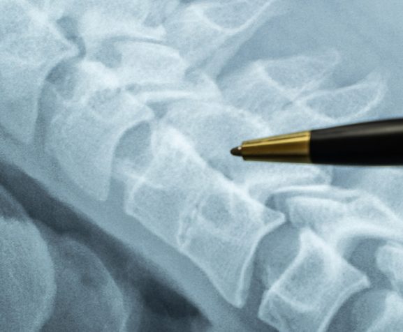 Doctor-showing-CT-MRI-scans-place-in-a-spine-between-vertebrae