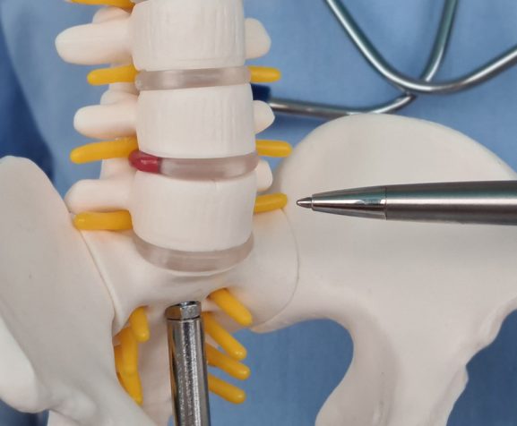 Doctor-shows-inflammation-and-pain-in-intervertebral-discs