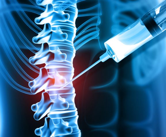 Human-spine-disease-and-spinal-injection-medication