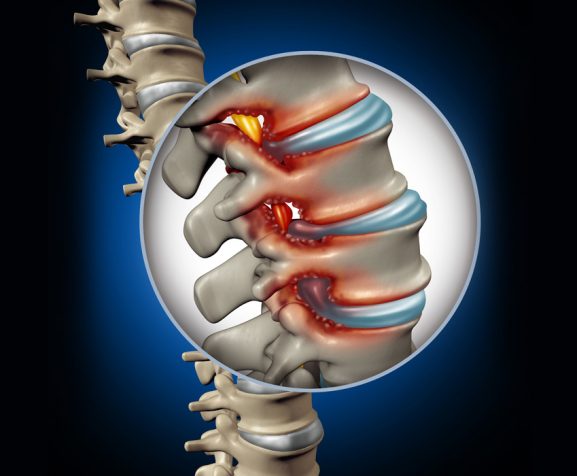 Image-showing-spinal-stenosis-medical-concept