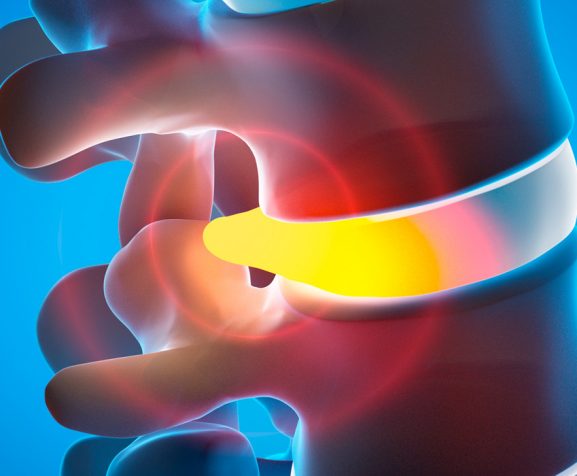 Part-of-human-spine-with-spinal-cord-under-pressure-of-intervertebral-disc