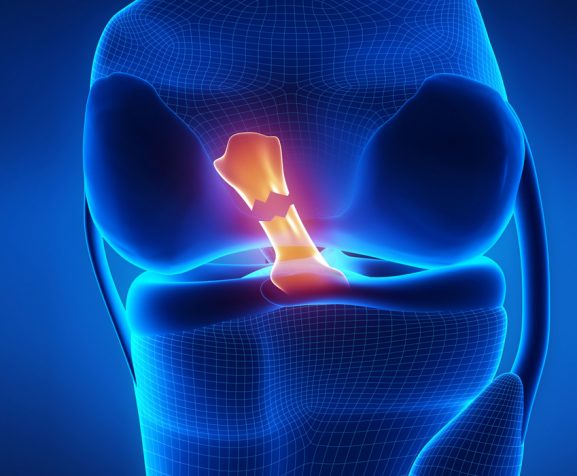 Torn-anterior-cruciate-ligament-in-x-ray-view